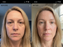 Karen L., Age 47, 6 weeks